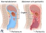 peritoneum_9d830a9d.jpg